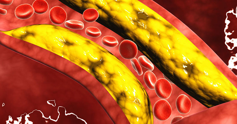 high-cholesterol-and-your-risk-for-heart-disease (1)